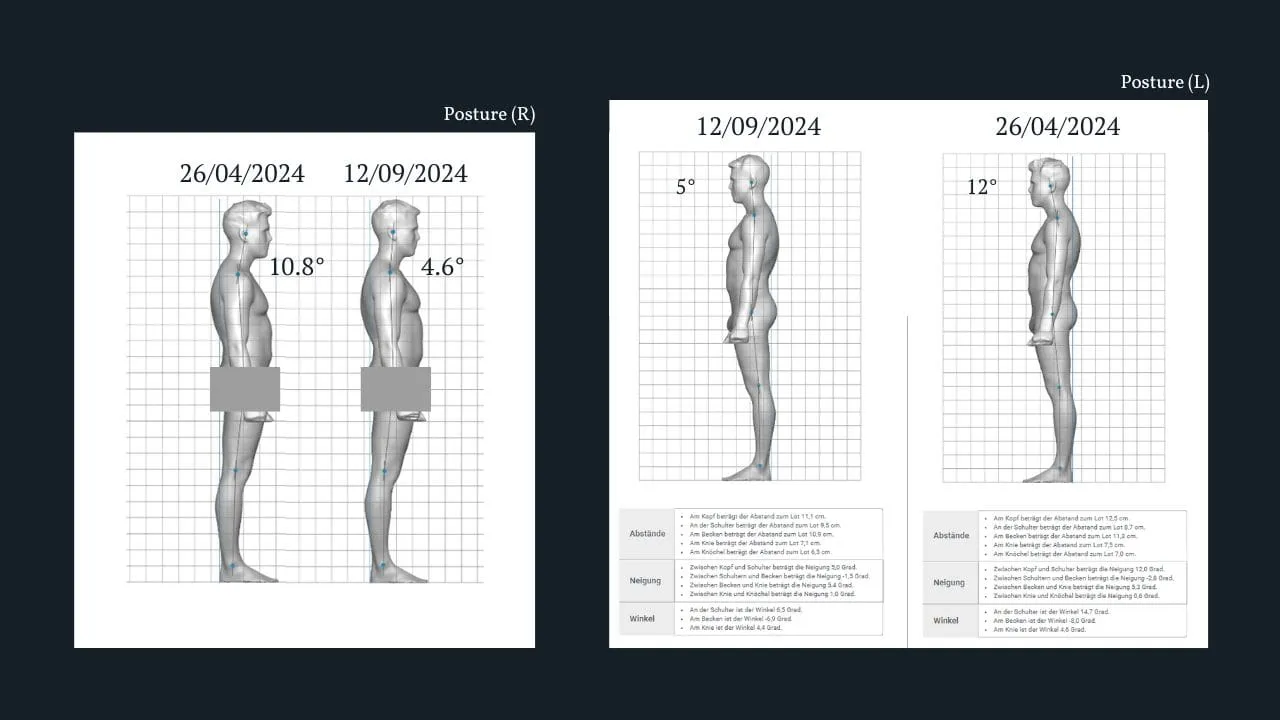 Scaneca side posture comparison before and after