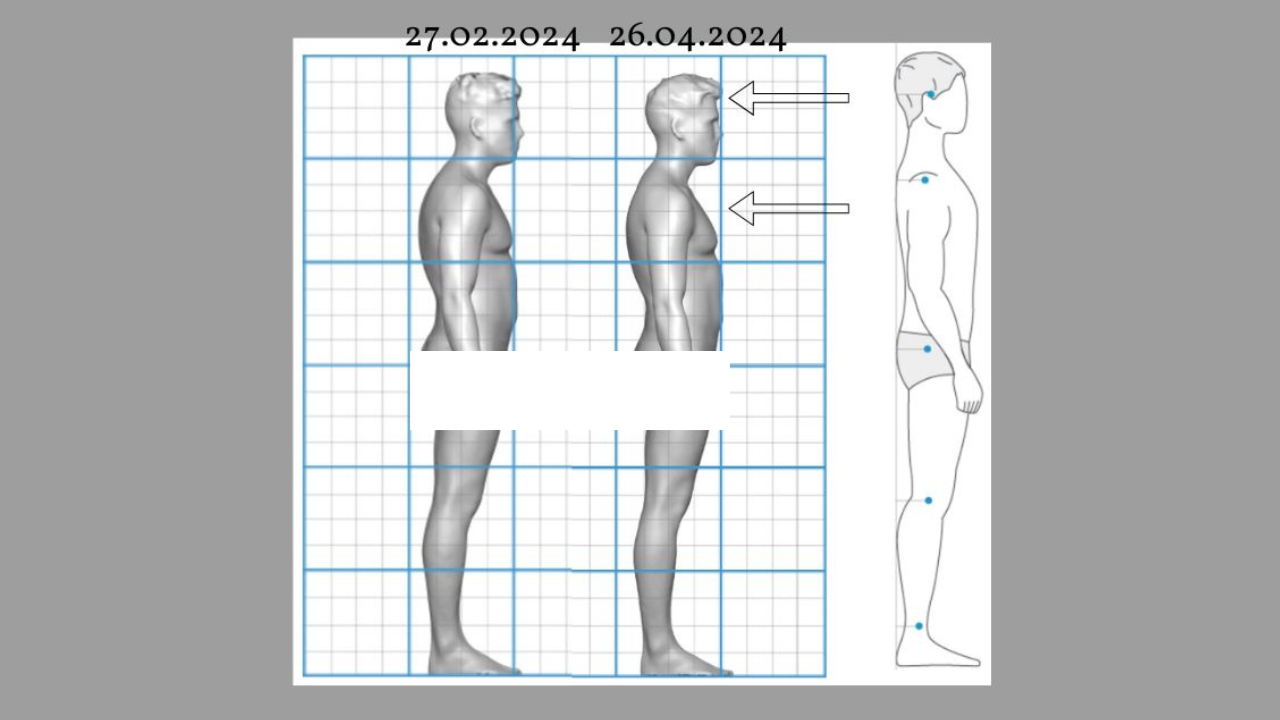 Comparison of posture improvement over two months, showing changes from February 27, 2024, to April 26, 2024. The side-by-side images illustrate enhanced spinal alignment and reduced forward head posture. The progress is highlighted by arrows pointing to key areas of improvement.